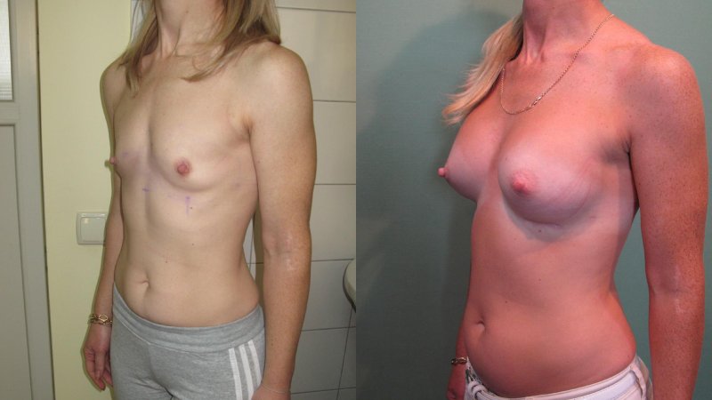 Breast plastic