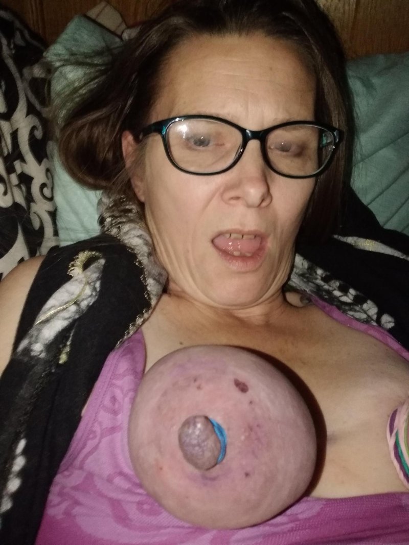 External hemorrhoids after childbirth