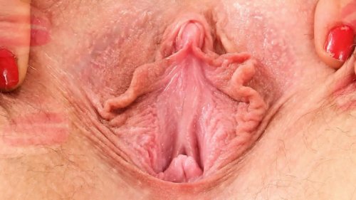 Sharp ends of condylomas
