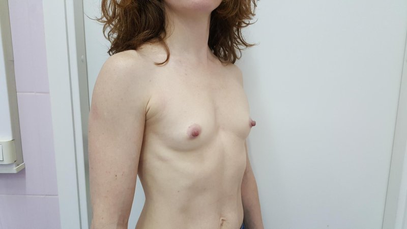 Breast plastic