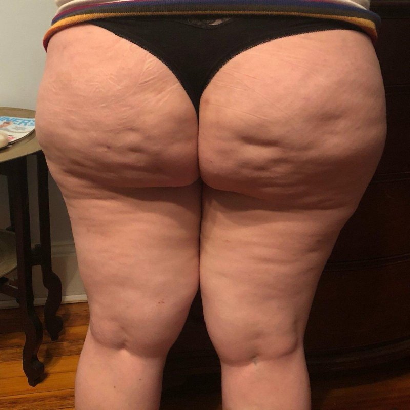 Lipodistrophy of cellulite