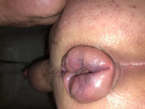 Extreme prolapse