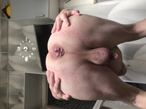 Combined hemorrhoids