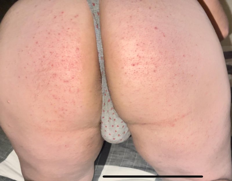 Erythema multiforme