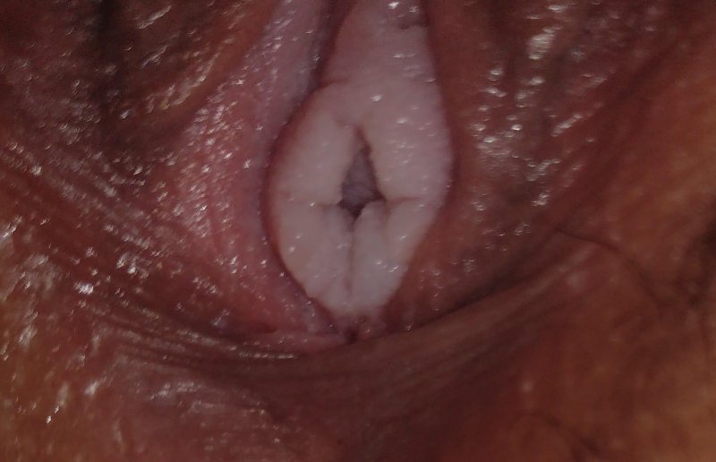 Nodes of the vocal cords