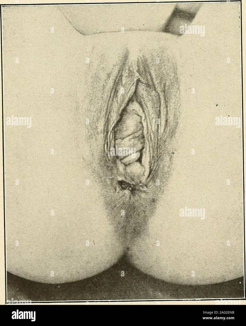 Vagina ulcers