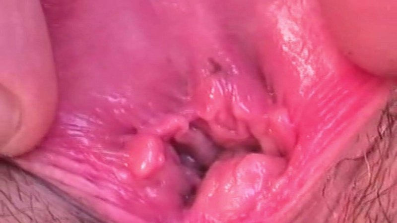 Papilloma in the vagina