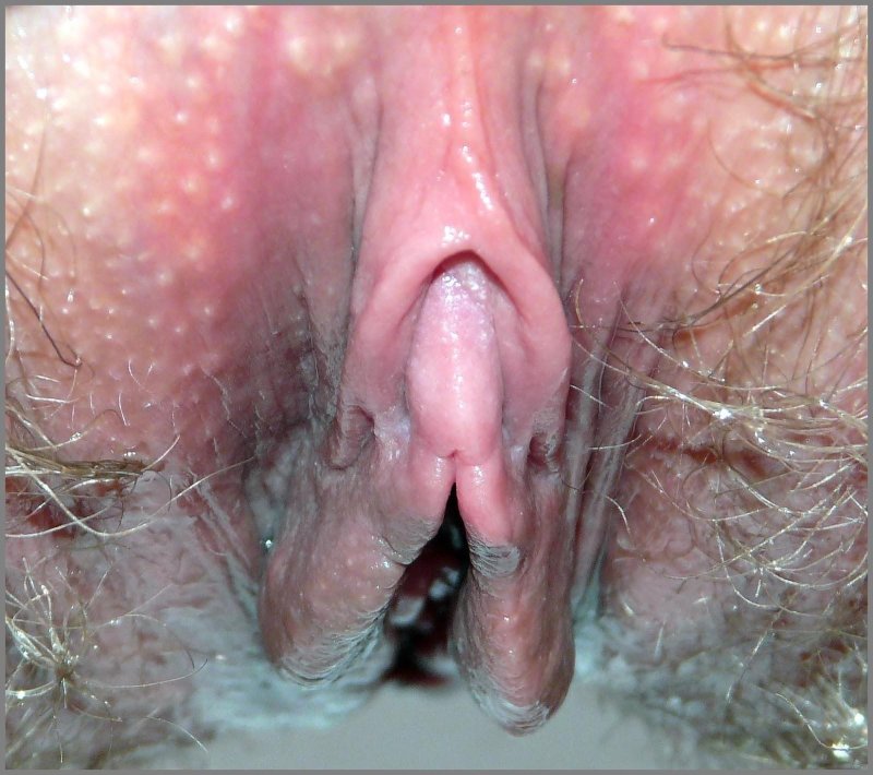 Anogenital condylomas