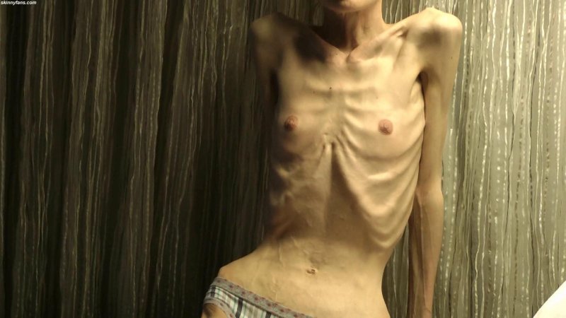 Naked anorexics