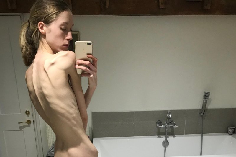 Girl with anorexia