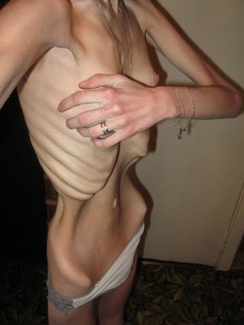 What is anorexia