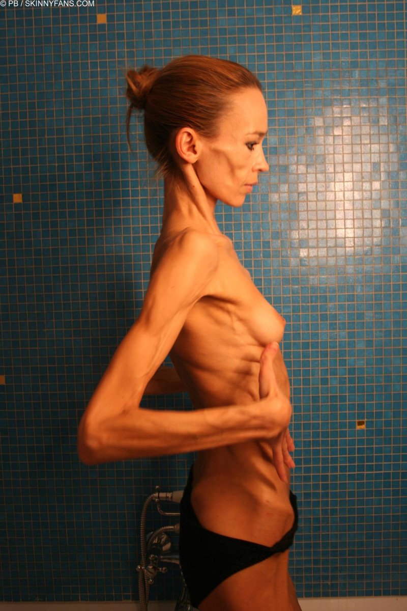 Anorexic cachexia