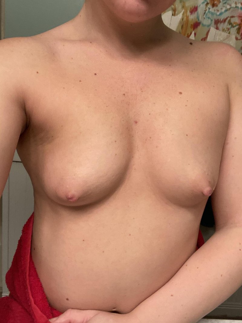 Breast plastic