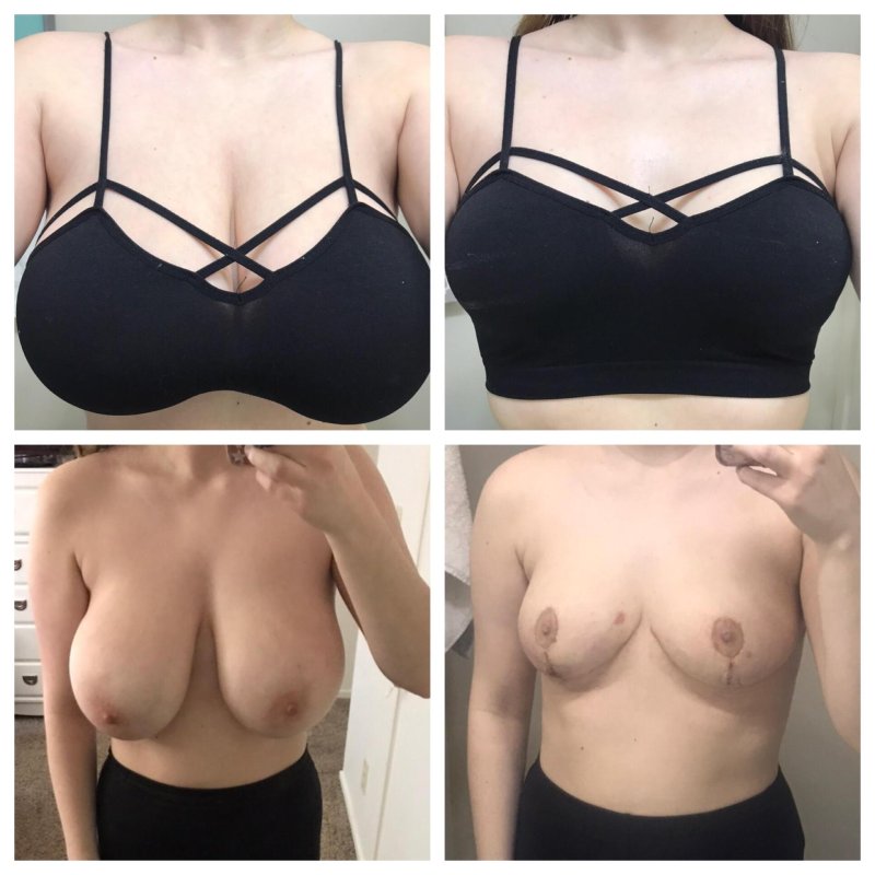 For breast augmentation