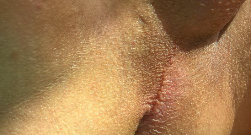 Inguinal epidermophytosis