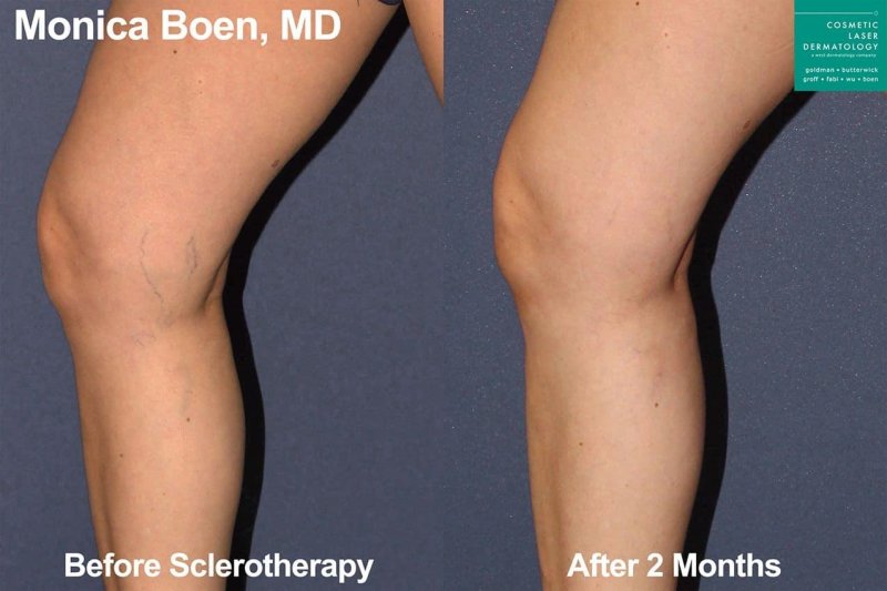 Operation on the veins of lower extremities