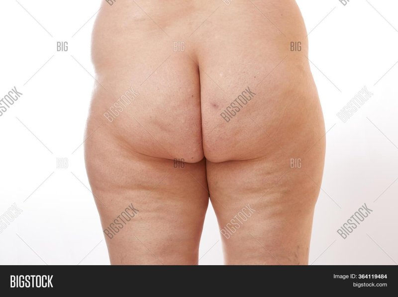 Big cellulite buttocks