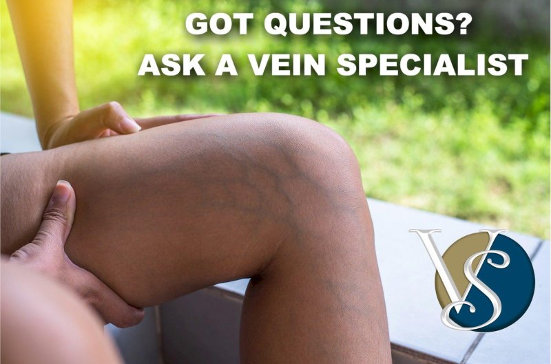 Varicose veins treatment
