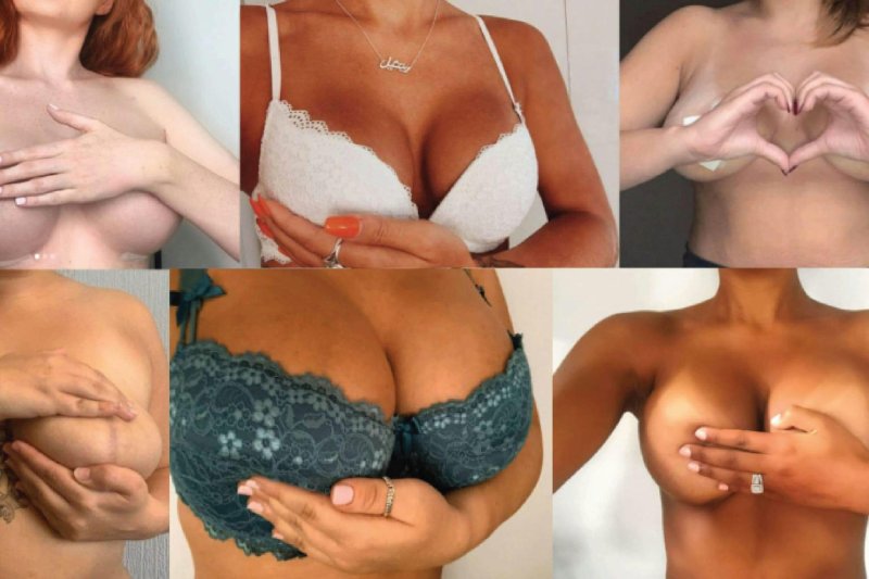 Breast augmentation