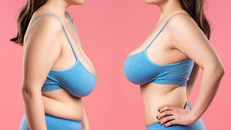 Sagging breasts