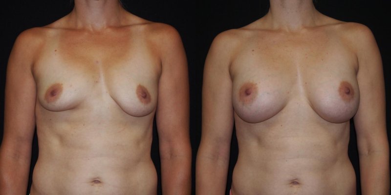 Breast plastic
