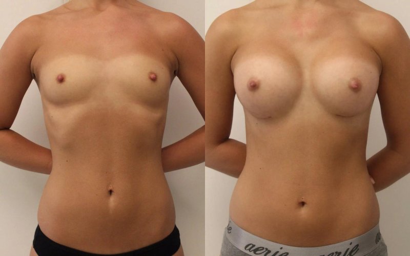 Breast enlargement
