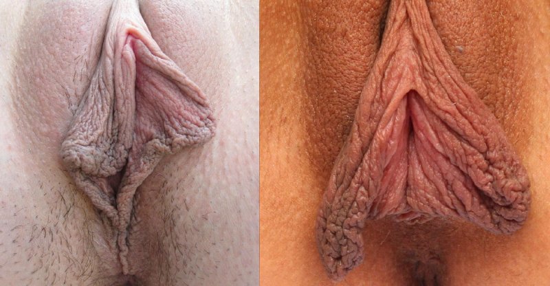 Very large labia