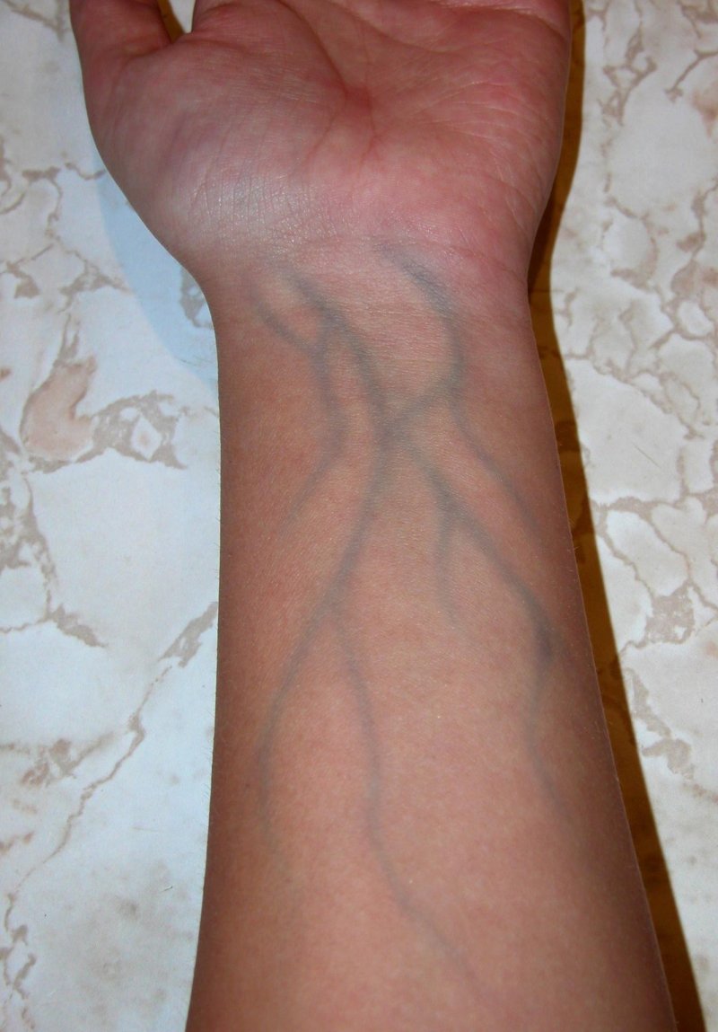Blue vein