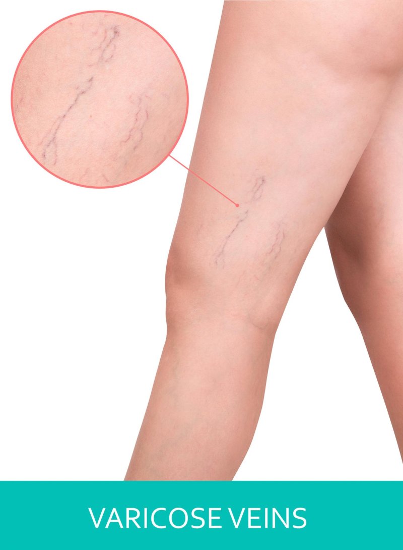 Sclerotherapy varicose veins