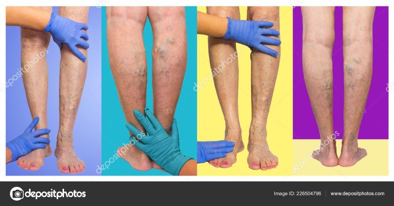 Venous deficiency