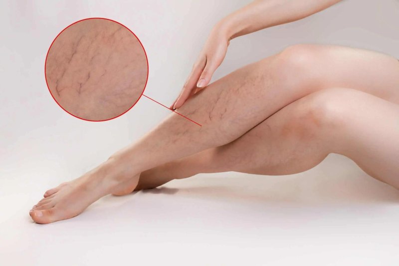 Varicose veins