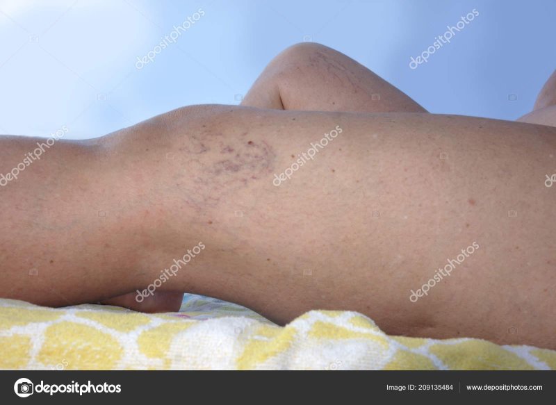 Vascular mesh on the legs