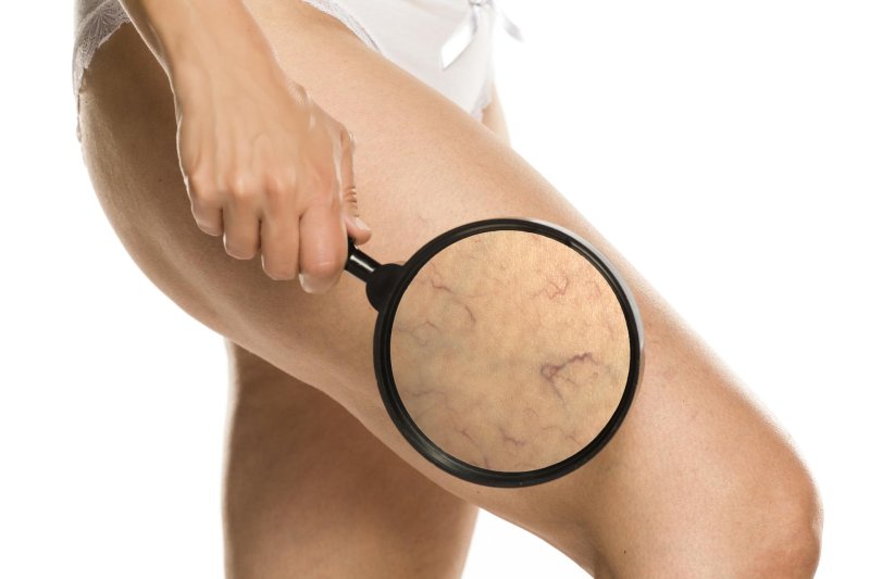 Varicose veins