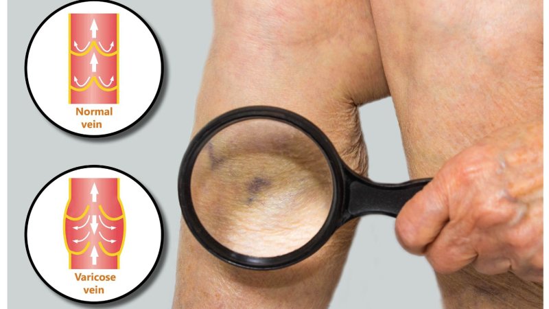 Cream for the treatment of varicose veins
