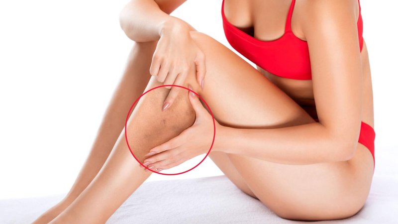 Cellulite on the hips