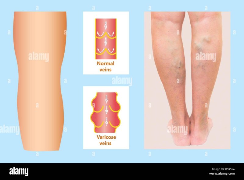 Varicose veins