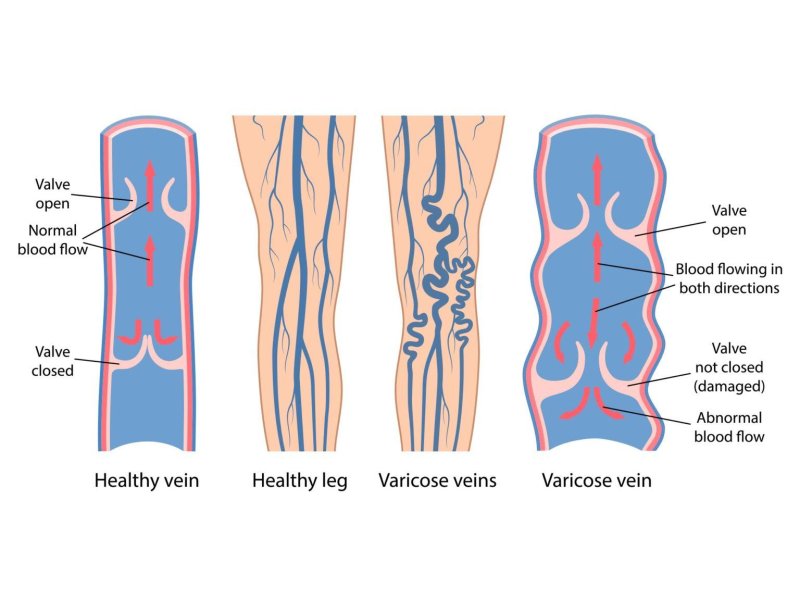 Varicose Veins Stick
