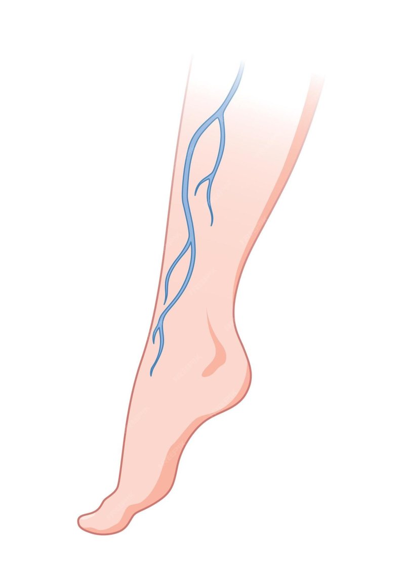 Varicose veins of the lower extremities