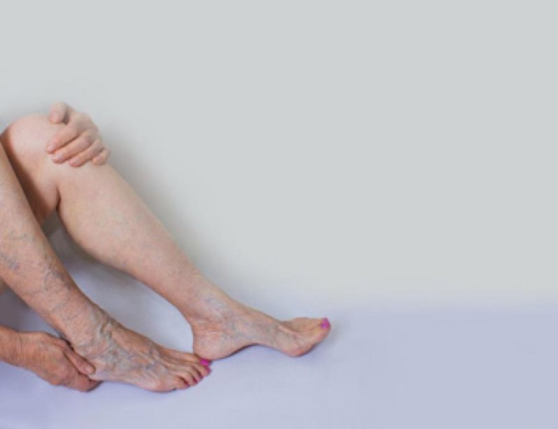 Varicose veins treatment
