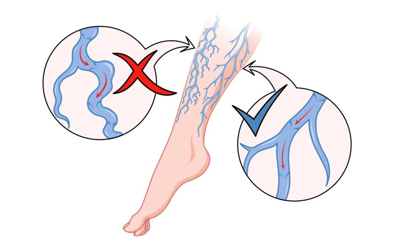 Varicose veins