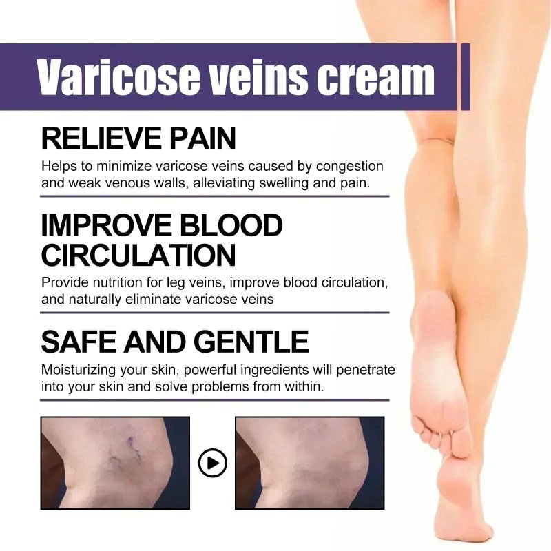 Cream from varicose veins
