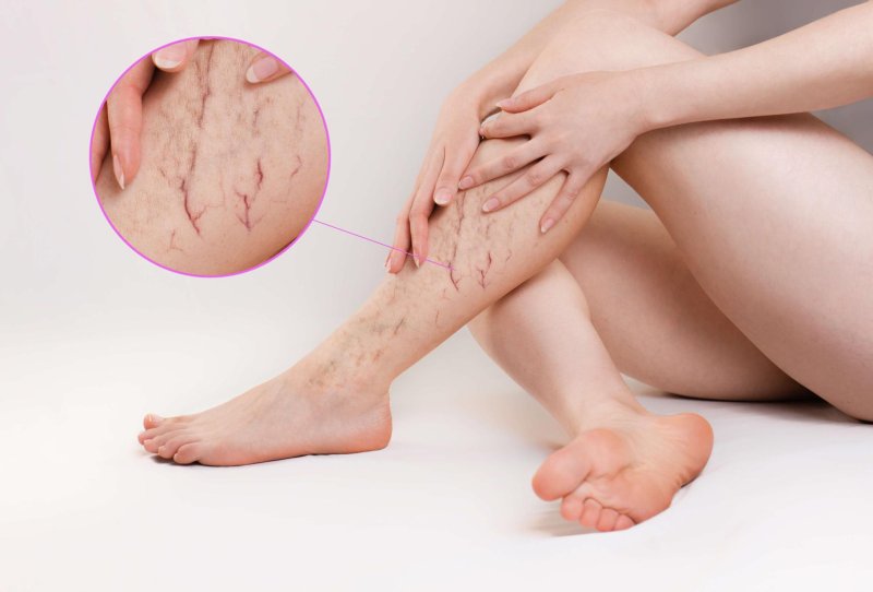 Vessels on the legs