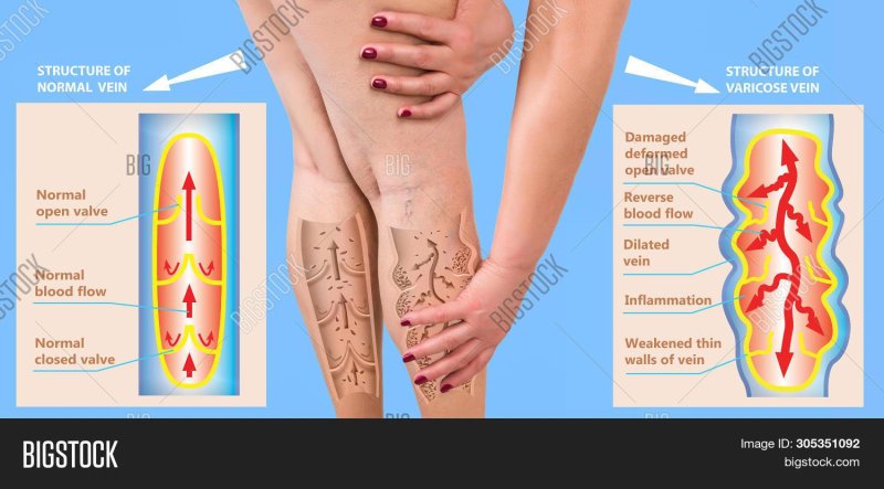 Varicose veins of the lower extremities