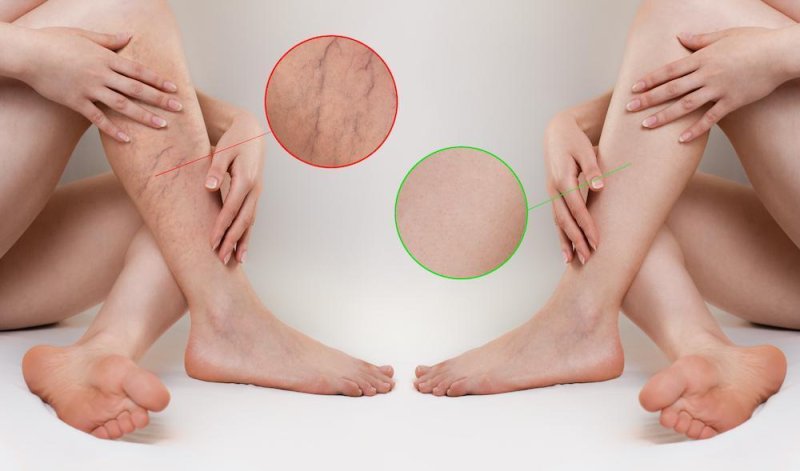 Varicose veins on the legs
