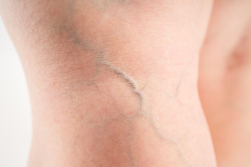 Feet veins
