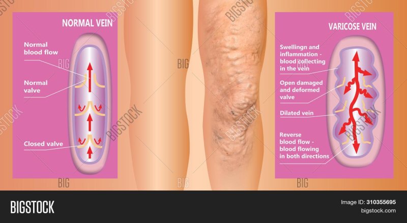 The structure of normal and varicose veins