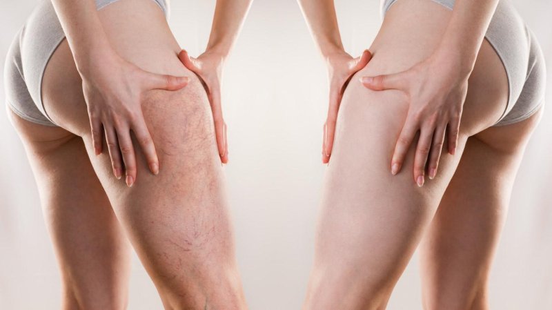 Cellulite on the legs