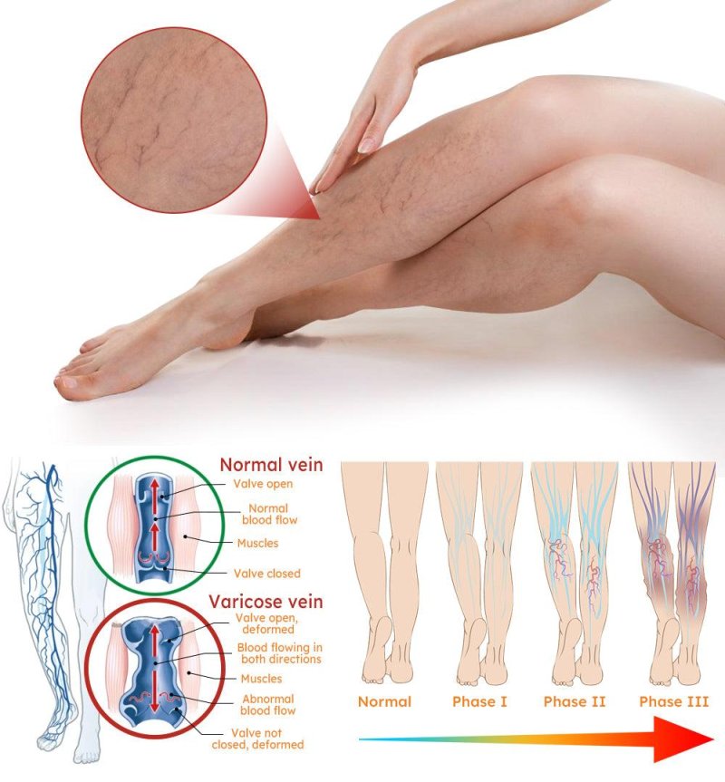Varicose Veins Cream China