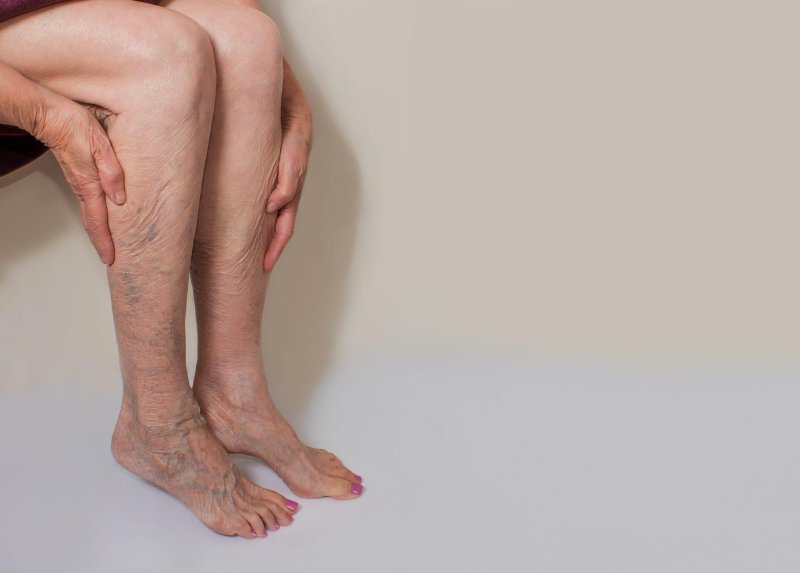 Varicose extension of the veins foot