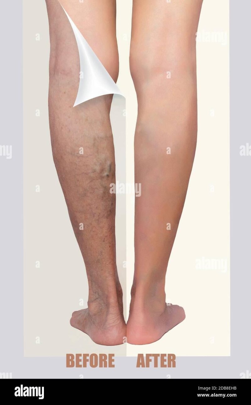 Varicose veins of the lower extremities